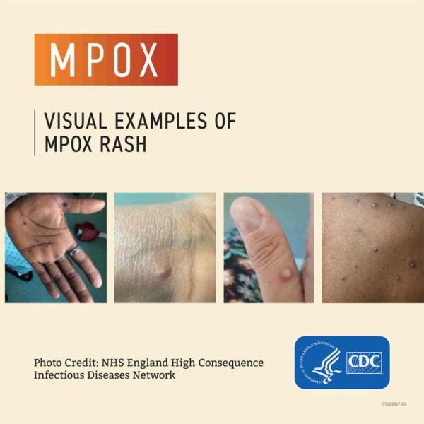 M-pox